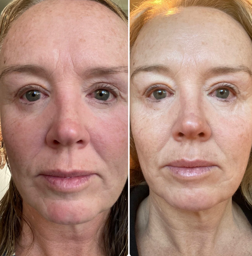 Velvinor™ | Soin Facial LED Anti-Âge