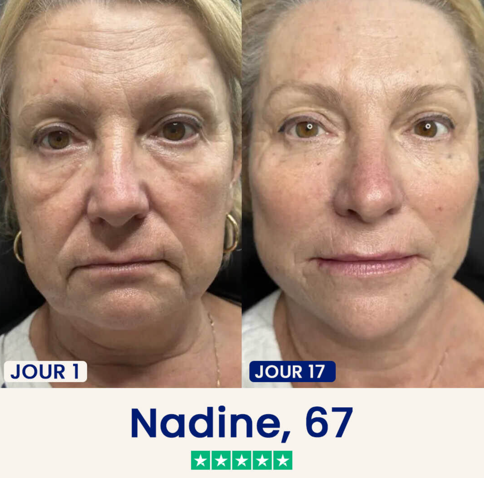 Velvinor™ | Chinology Masque Liftant V-Line